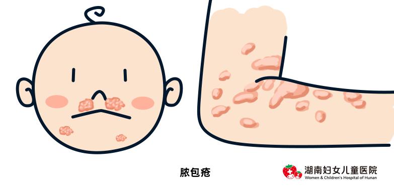 儿童身上皮疹反反复复怎么办,全身皮疹怎样止痒