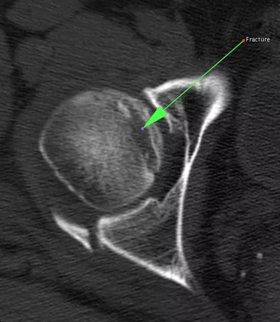 所有骨折都叫什么名字,骨折的名称有哪些