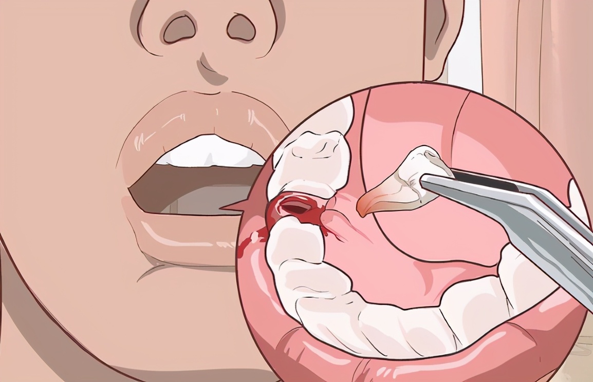 拔牙后怎样能促进牙洞愈合,牙龈伤口一年还没愈合怎么治疗