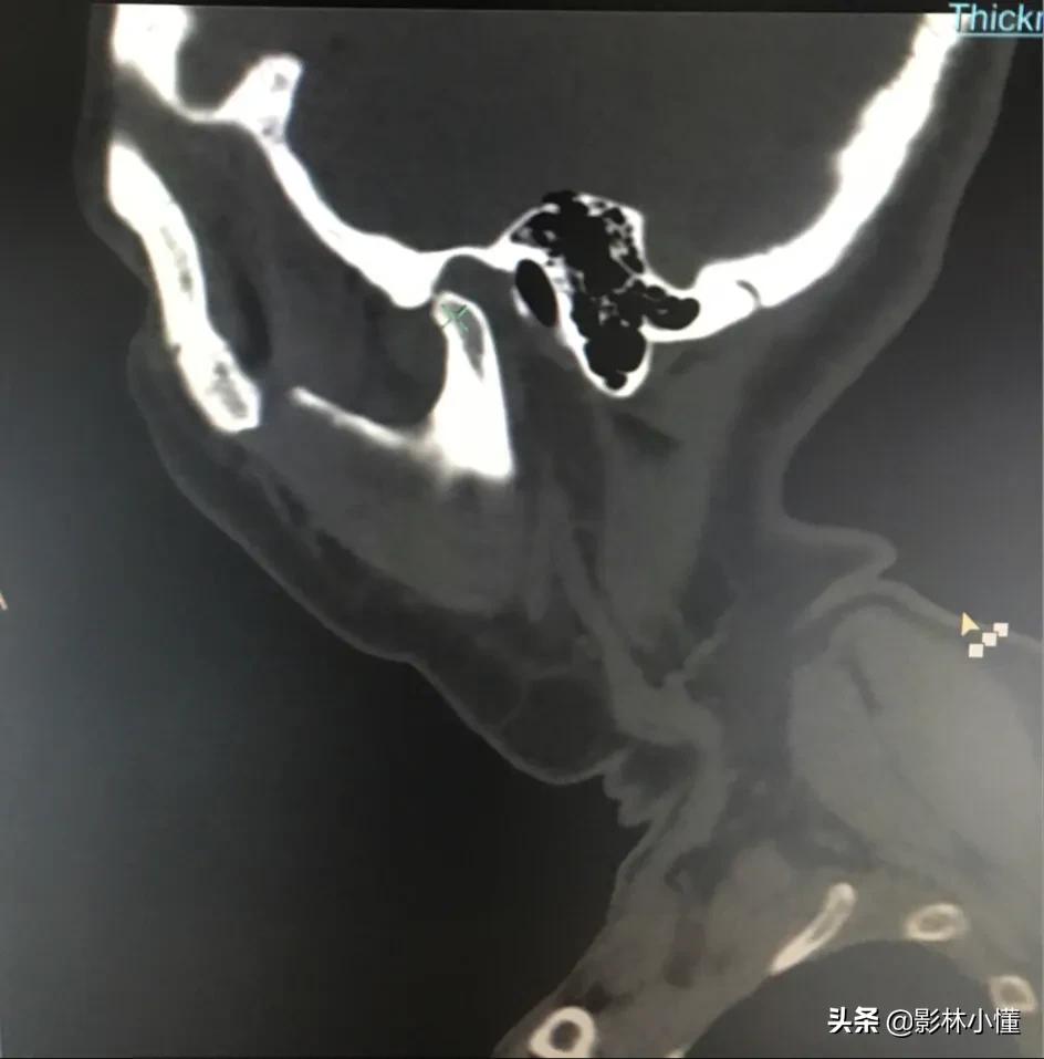 张口受限出现了咯噔声音,张口受限关节弹响怎么回事