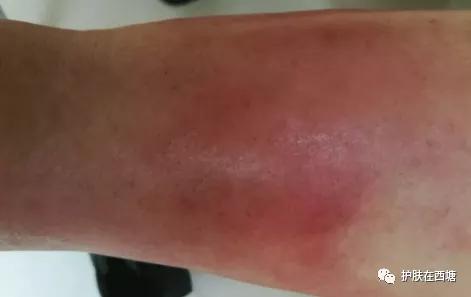 链球菌感染导致皮肤病,革兰氏阳性球菌皮肤病