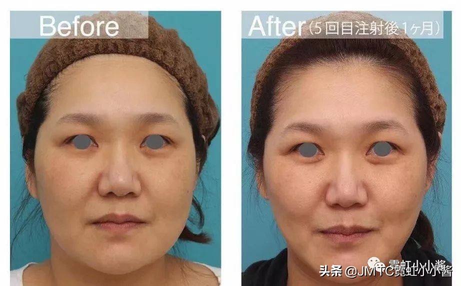 记录翻译小姐姐日本打溶脂针,肉脸变骨感脸全过程|日本医美