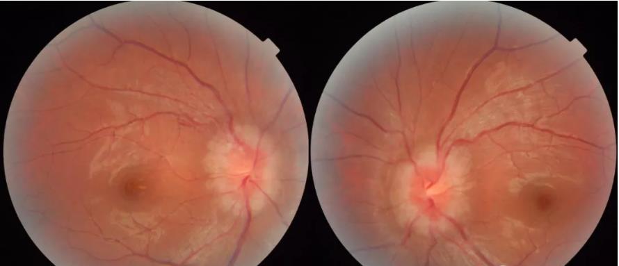 颅高压第一篇：视乳头水肿