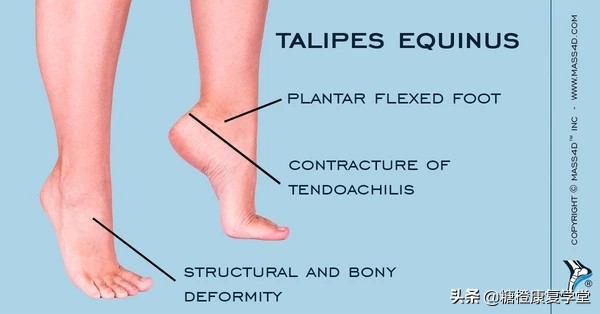 马蹄足内翻为什么一个大一个小,马蹄内翻足腿不一样大小怎么办