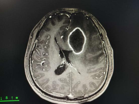 挤痘一时爽，挤完脑脓肿？|健康问答133期
