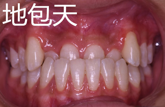 30岁还可以牙齿矫正吗,30岁牙齿矫正一般多少钱