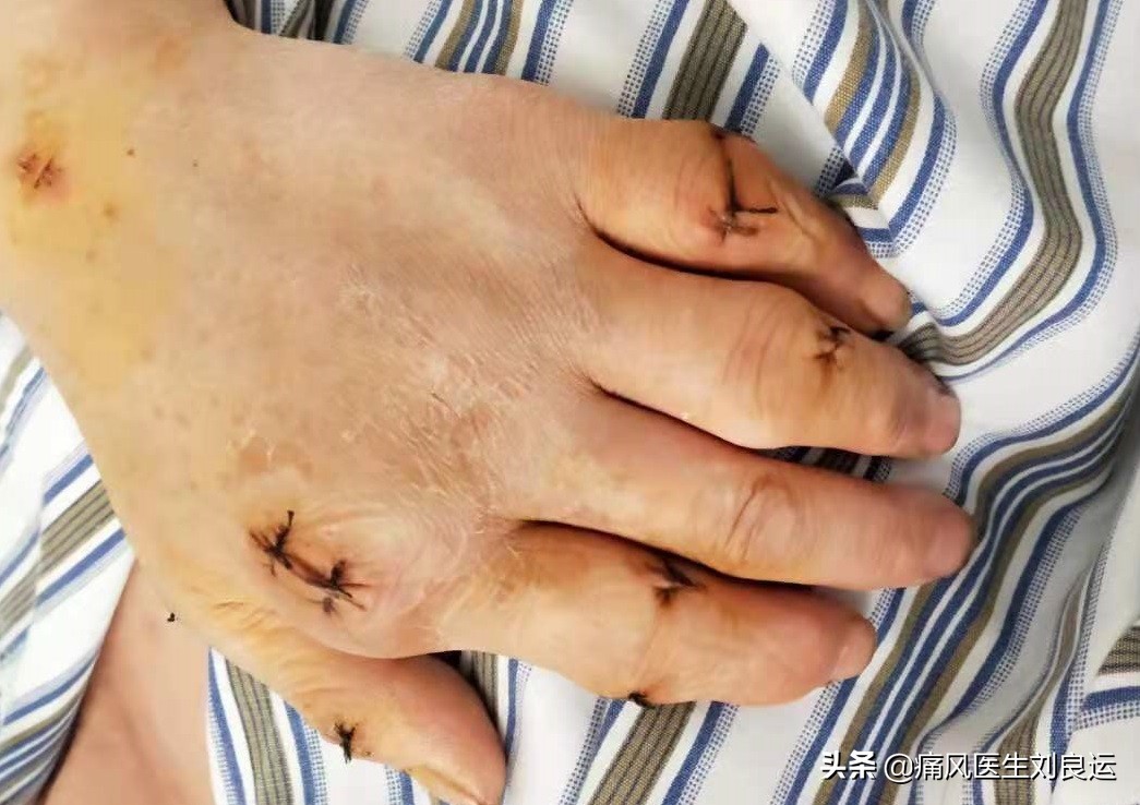 痛风发作怎么避免有痛风石,痛风长石头吗