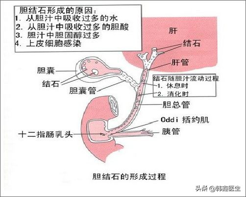 胆囊健康科普知识,胆囊结石健康知识