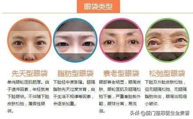 医美去除眼袋多少钱,眼袋皱纹怎么去除医美