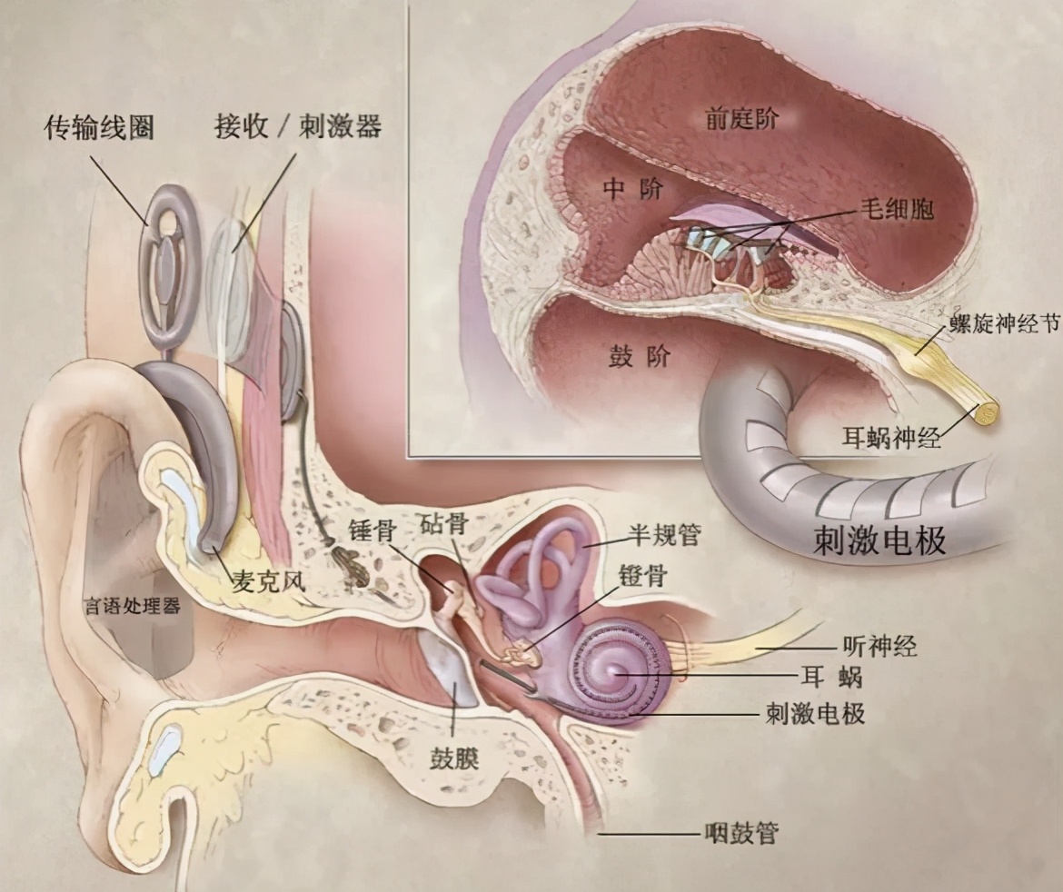 感觉神经性耳聋佩戴电子耳蜗,极重度双耳聋可以植入单侧耳蜗吗