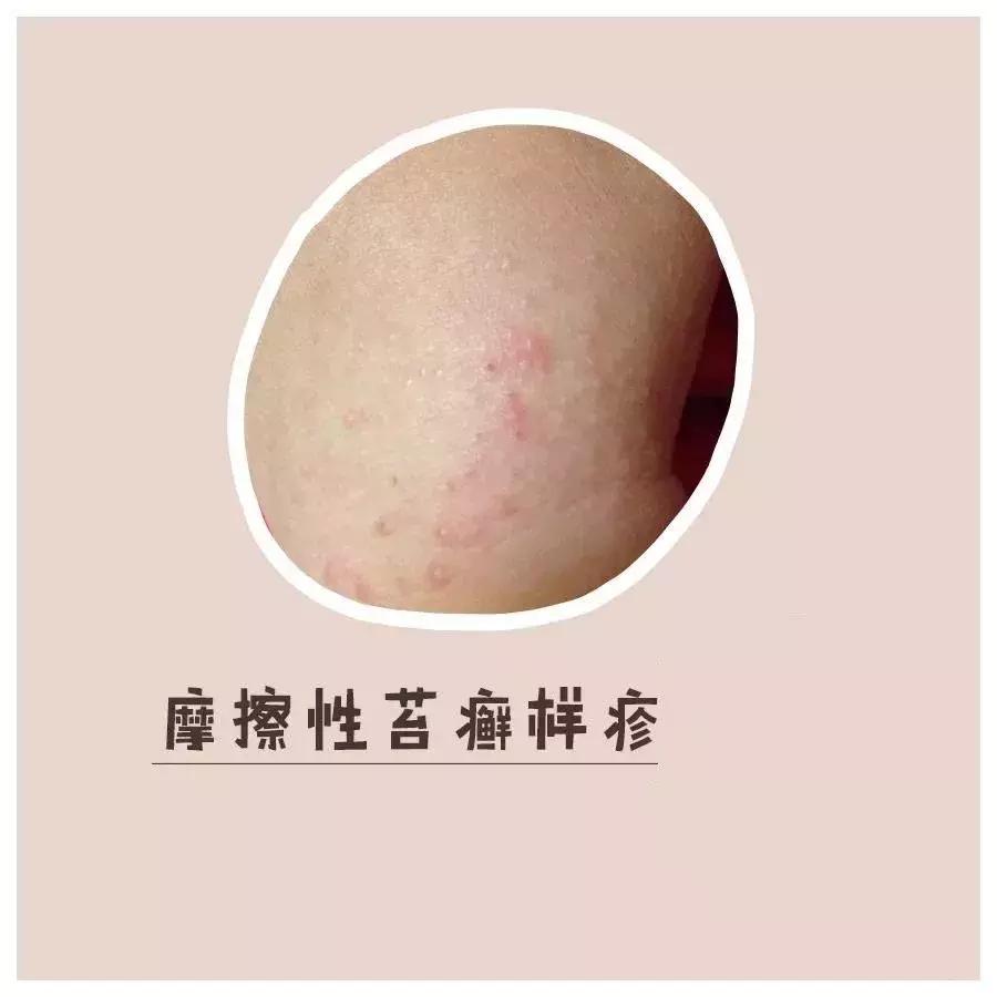 儿童摩擦性苔藓样疹怎么得的,苔藓的症状和治疗方法