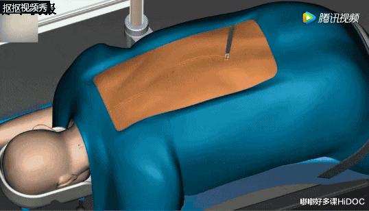 儿童颈椎侧弯会有什么后果,13岁孩子颈椎侧弯矫正睡姿图片