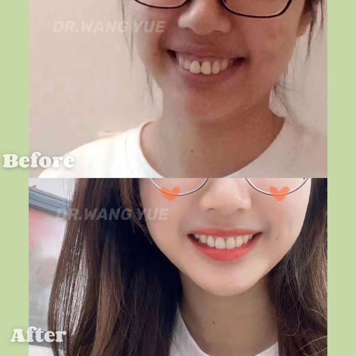 上海舌侧正畸医生,上海舌侧矫正哪家好