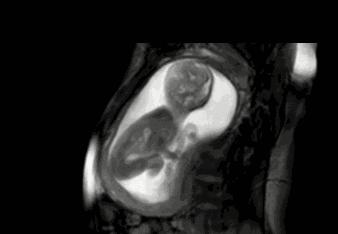 孕晚期数胎动怎么算一次,孕妇如何数一小时内胎动次数