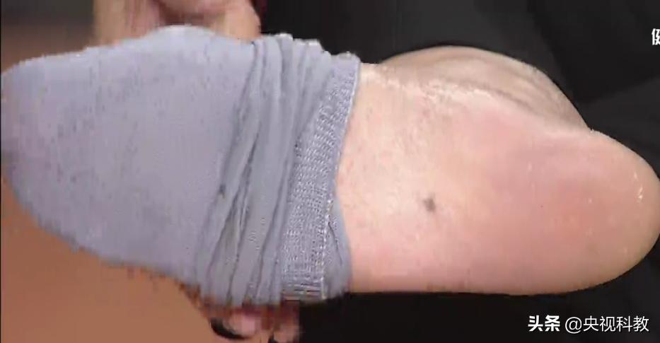 黑痣很容易恶变吗,身上黑痣出现什么状况有癌变发生