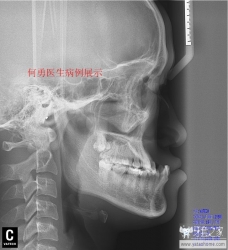 正畸医生如何指定方案的,正畸医生怎么说