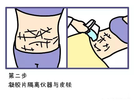 酷塑冷冻溶脂副作用是什么样的,酷塑冷冻溶脂的真实经历对比