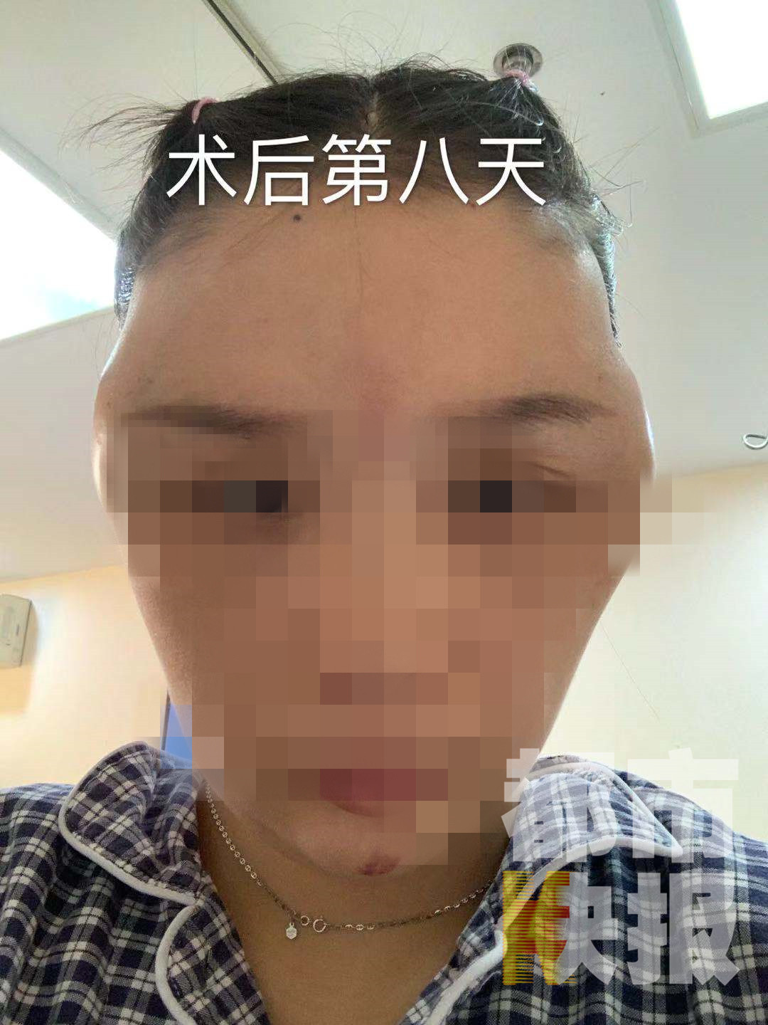 宝鸡女子在朋友医美店打针花一万七却“美容变毁容”