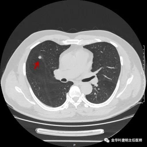 医者仁心过度治疗,肺实性结节多大需手术