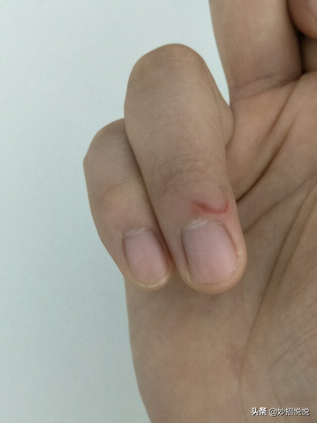 不小心划破了怎么避免留疤,被划伤用什么药愈合得快一点