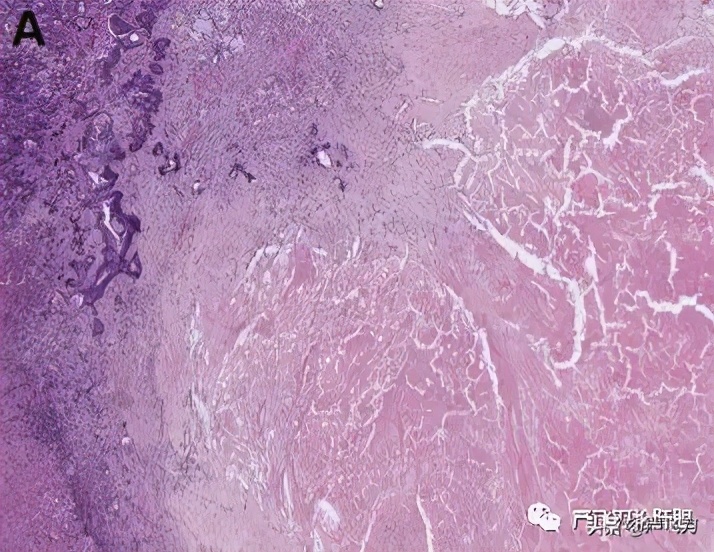 结直肠癌肝转移的介入治疗,结直肠癌肝转移的生物学疗法