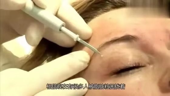 脂肪粒怎么用针挑出的,脂肪粒多久可以用针挑出来