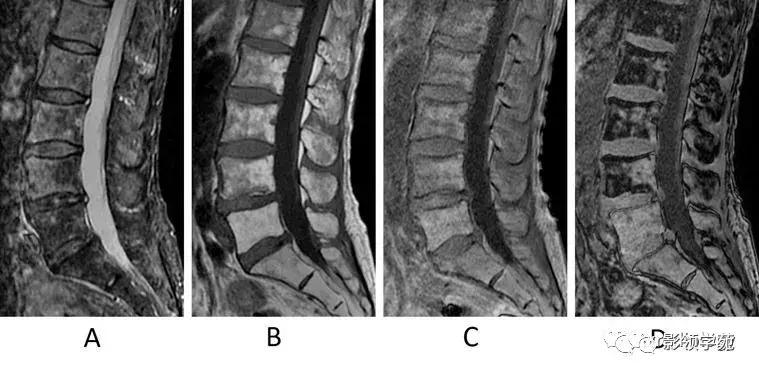 9种椎体和椎旁信号增高的非肿瘤性病变