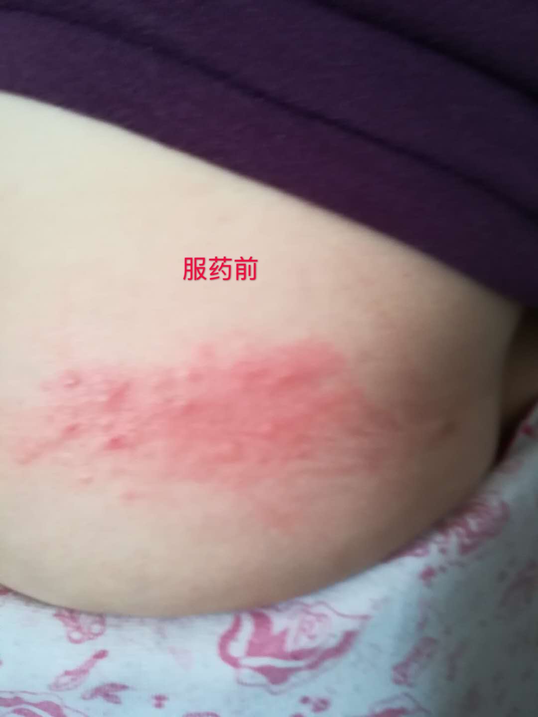 蛇缠腰带状疱疹的后遗症中医治疗,带状疱疹后遗症特效中医针灸治疗