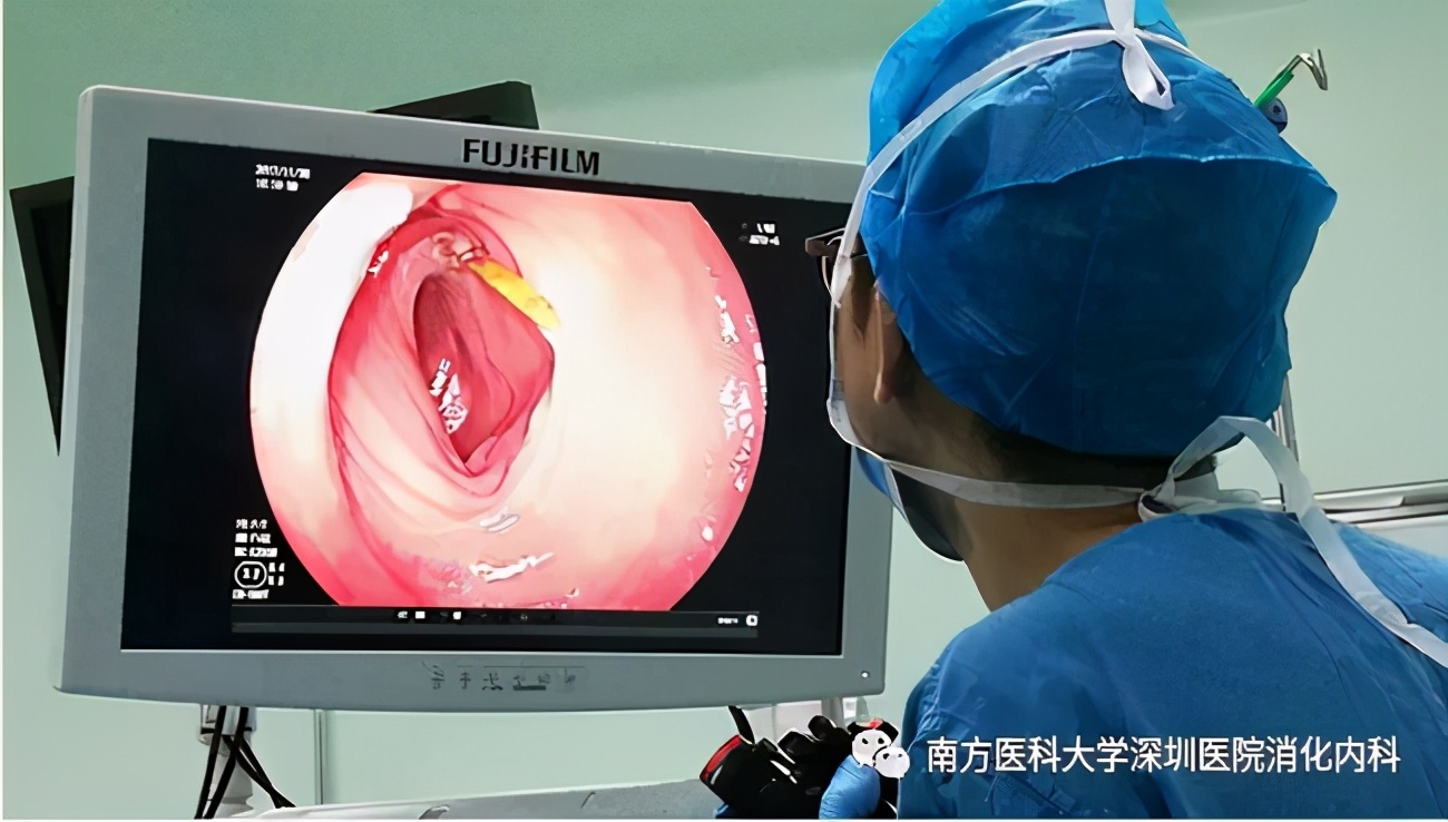 小肠异物取出手术步骤,小肠异物穿孔微创手术