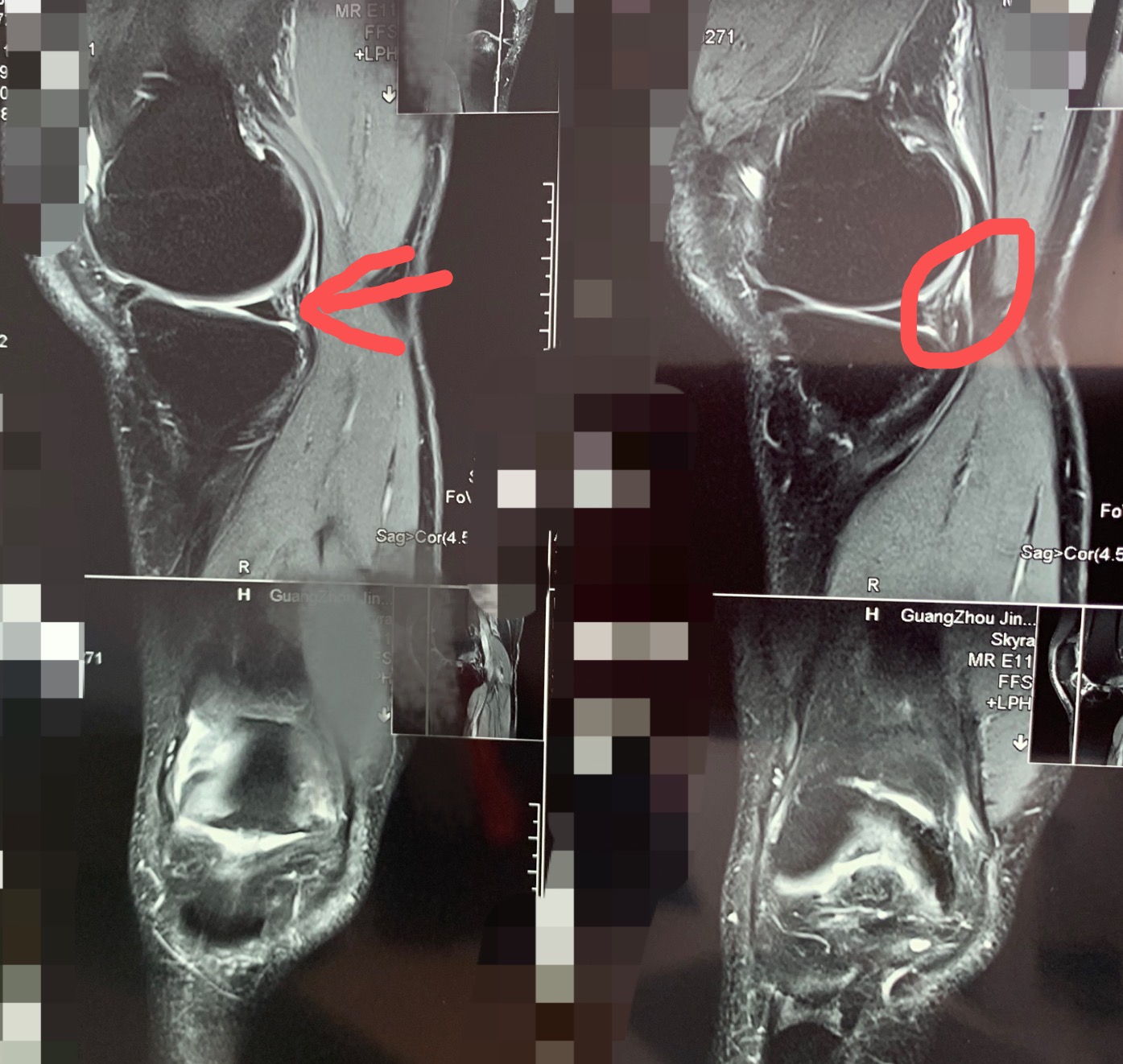 兰姆不是受伤了吗,兰姆受伤完整版