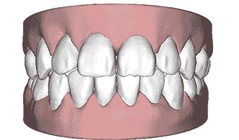 牙齿矫正别轻易拔牙,牙齿矫正要拔牙
