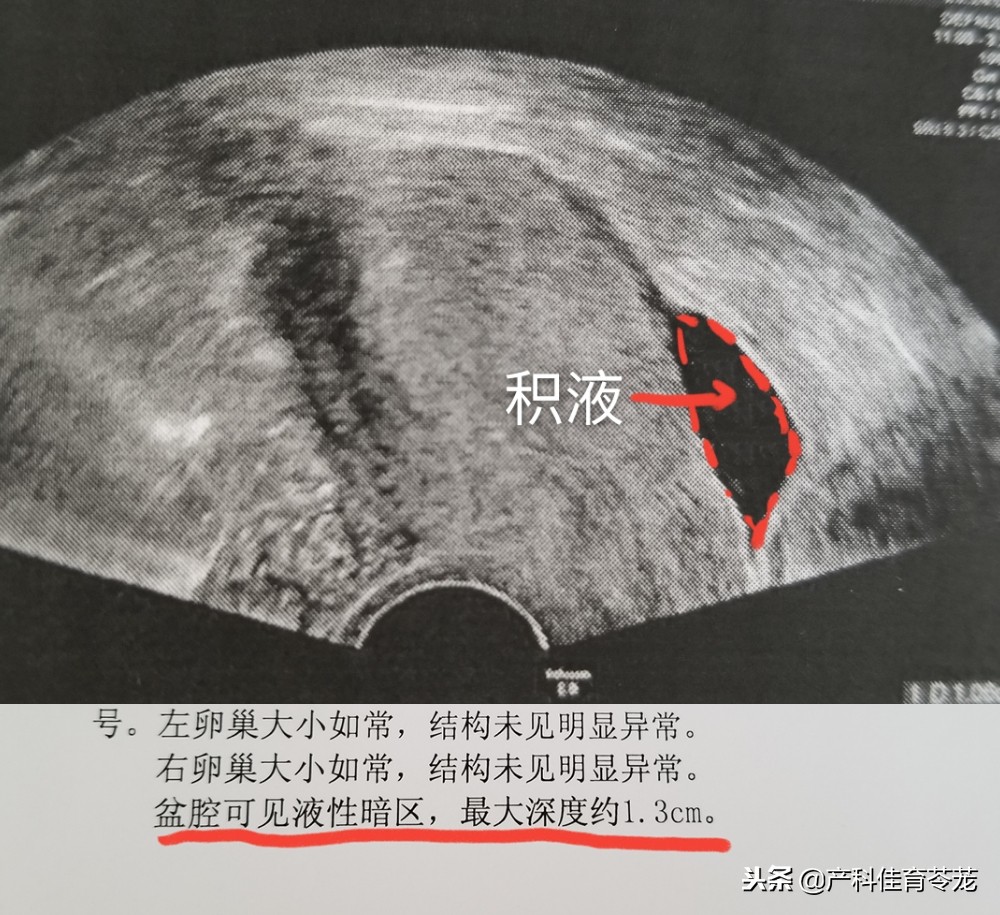 b超提示输卵管有积液,b超输卵管造影后为什么盆腔积水