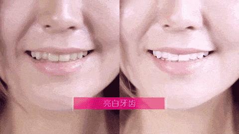 刘涛全瓷牙经验之谈,为什么刘涛说不要轻易做全瓷牙