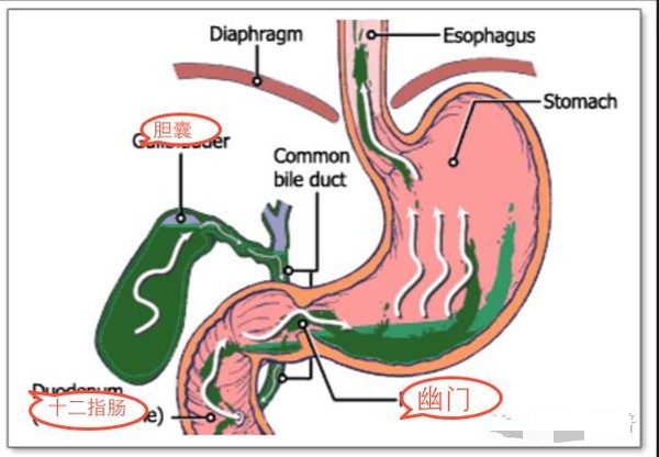 幽门螺旋杆菌胆汁反流胃炎怎么办,胆汁反流性胃炎与幽门螺杆菌有关