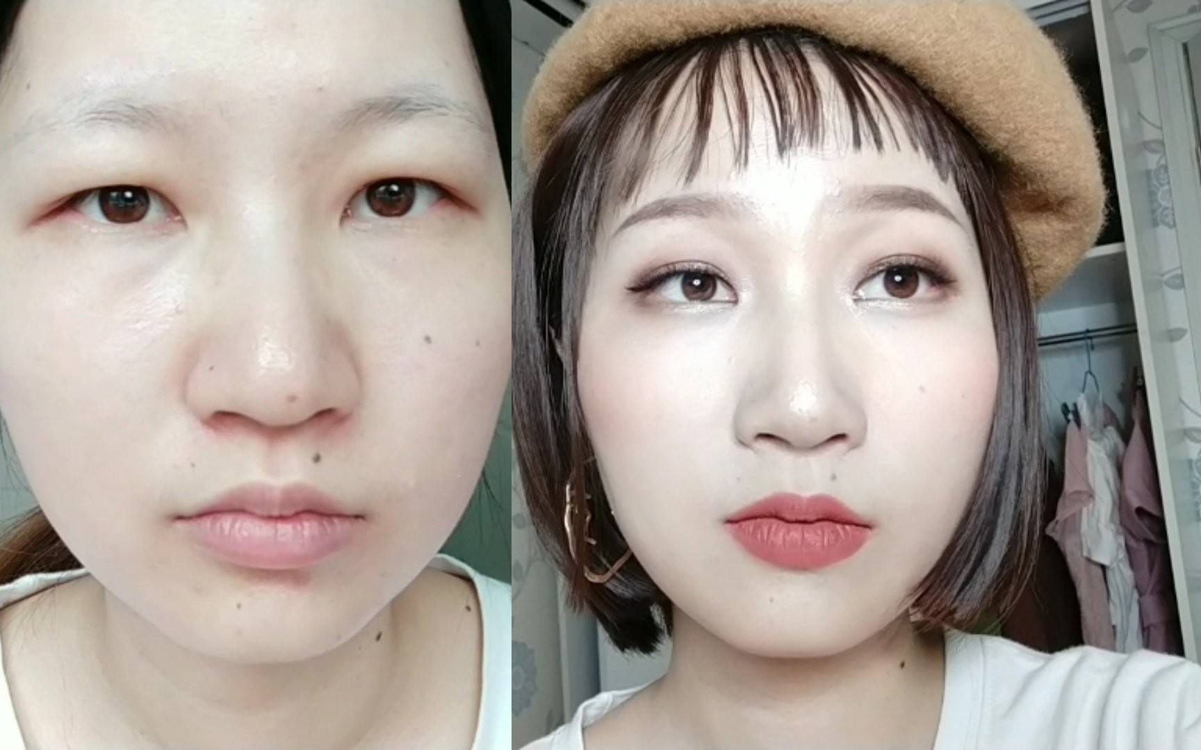 天生肿眼泡脂肪怎么消除,肿眼泡怎么分清皮肤厚和脂肪多