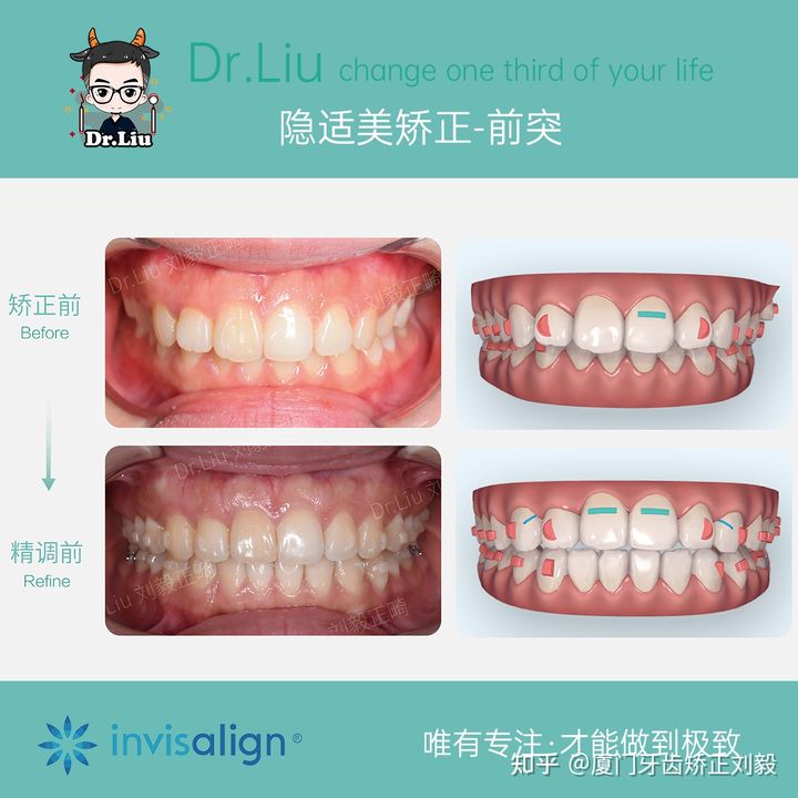 牙齿矫正厦门口腔医院,厦门隐形龅牙矫正优惠