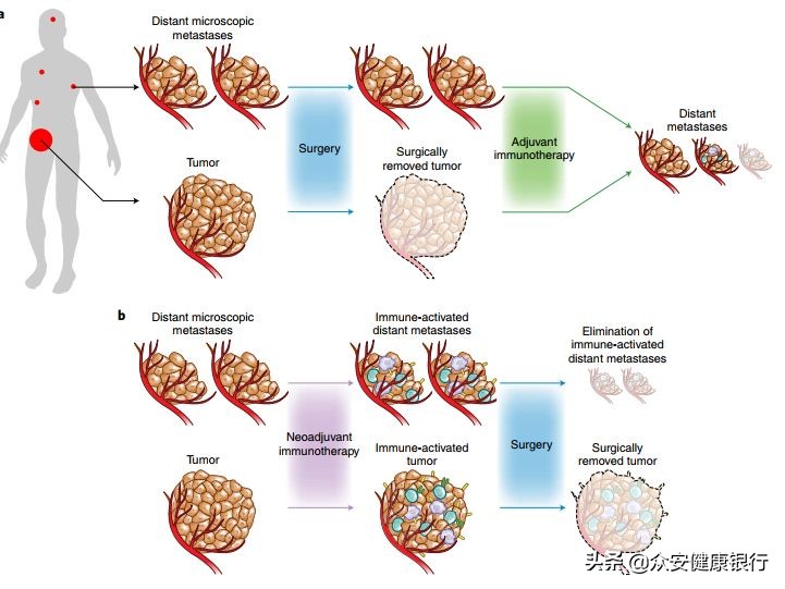 免疫治疗早期肺癌的效果如何,免疫治疗晚期肺癌的治愈率