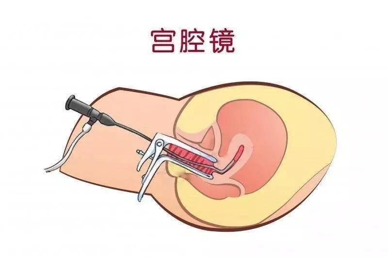 结婚10年,4次宫腔镜,2年试管,第4次移植终于迎来好孕