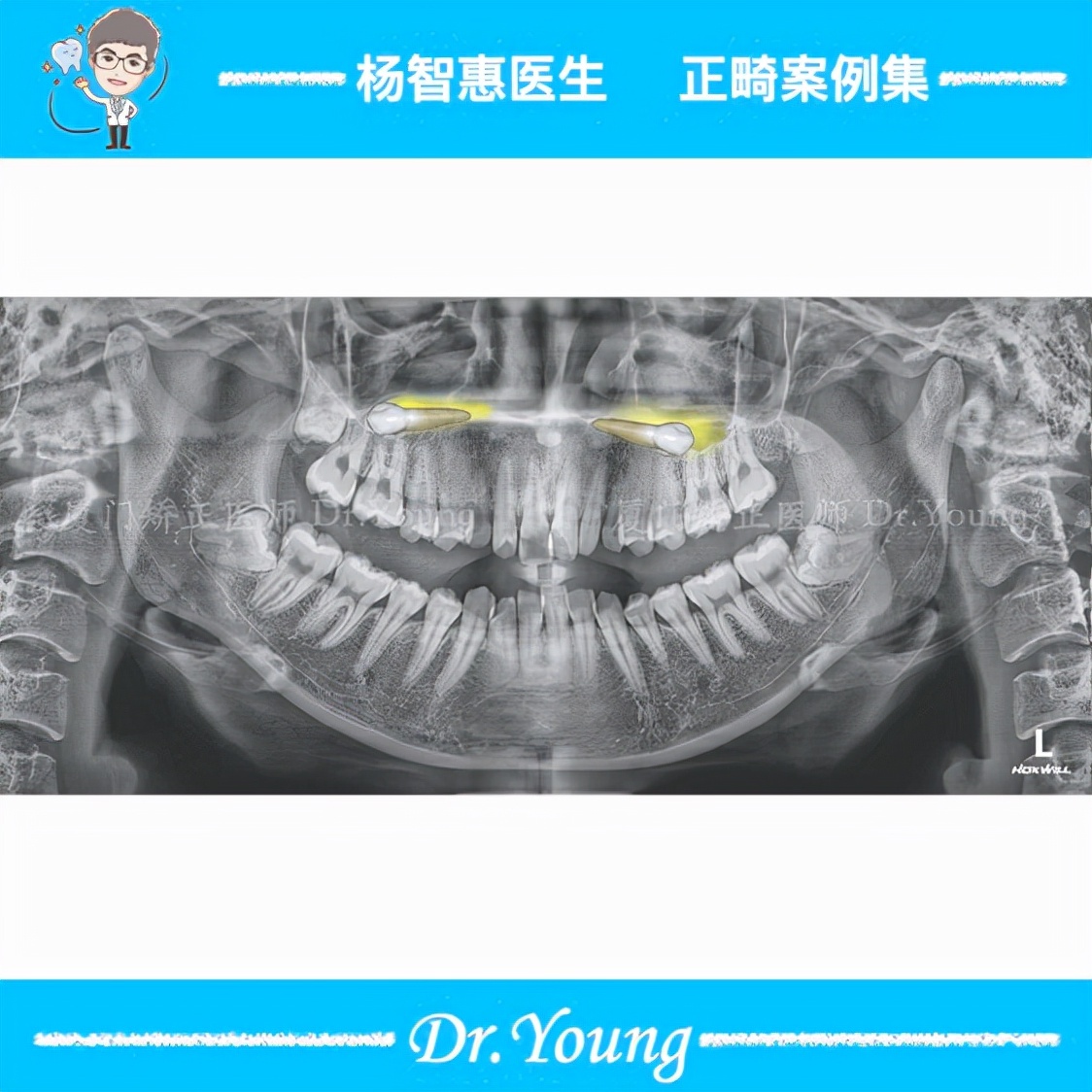 牙齿矫正牙列不齐案例,厦门儿童牙齿矫正龅牙前突