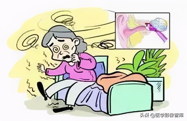 什么是眩晕的症状,什么是眩晕症图片