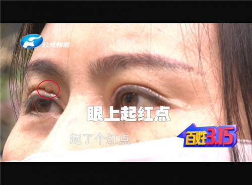 郑州市修复双眼皮,双眼皮缝线处发炎脓包怎么处理