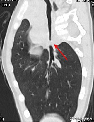 小儿气管镜怎么检查,小儿ct检查全过程视频