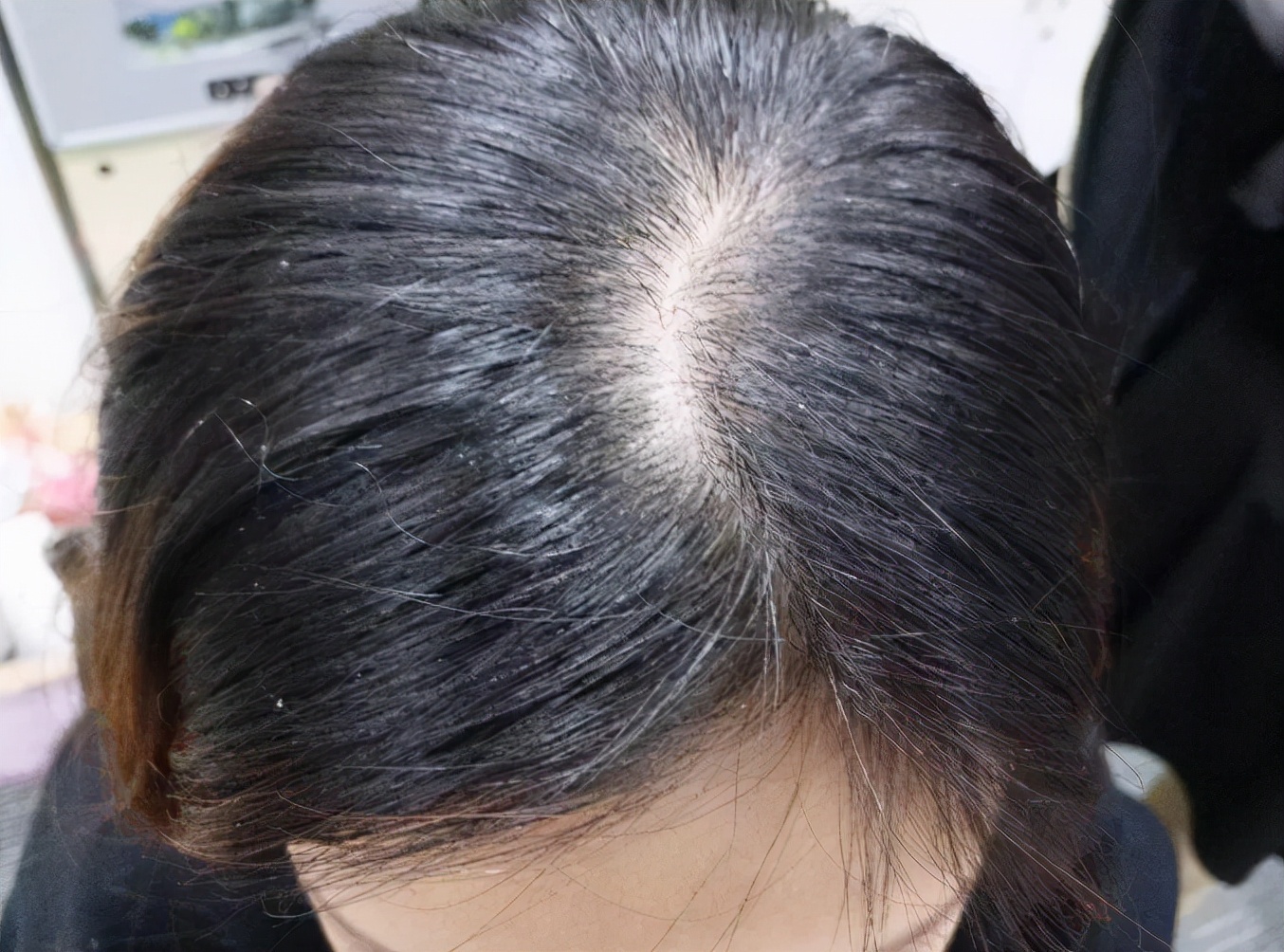 头皮长了个疙瘩破了怎么办,头皮为啥老长粉刺之类的疙瘩