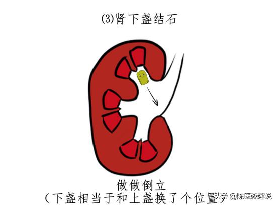 发现肾结石怎样治疗更好,发现肾结石怎么办