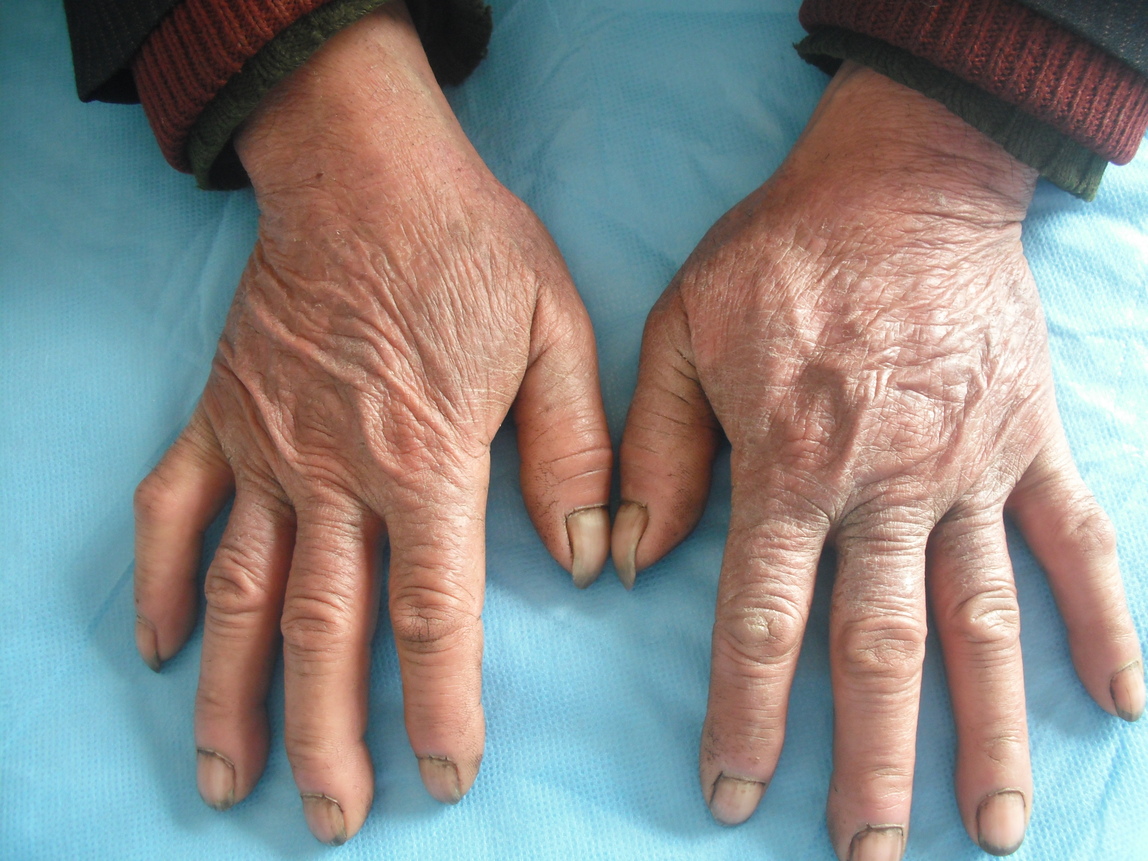 光过敏/多形性日光疹