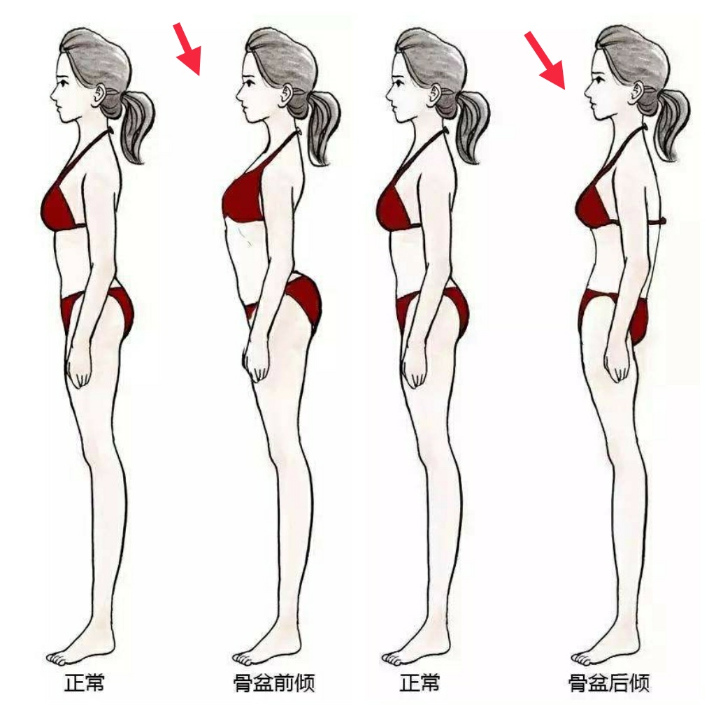 右侧骨盆前倾的最有效的矫正方法,下交叉综合症骨盆前倾矫正