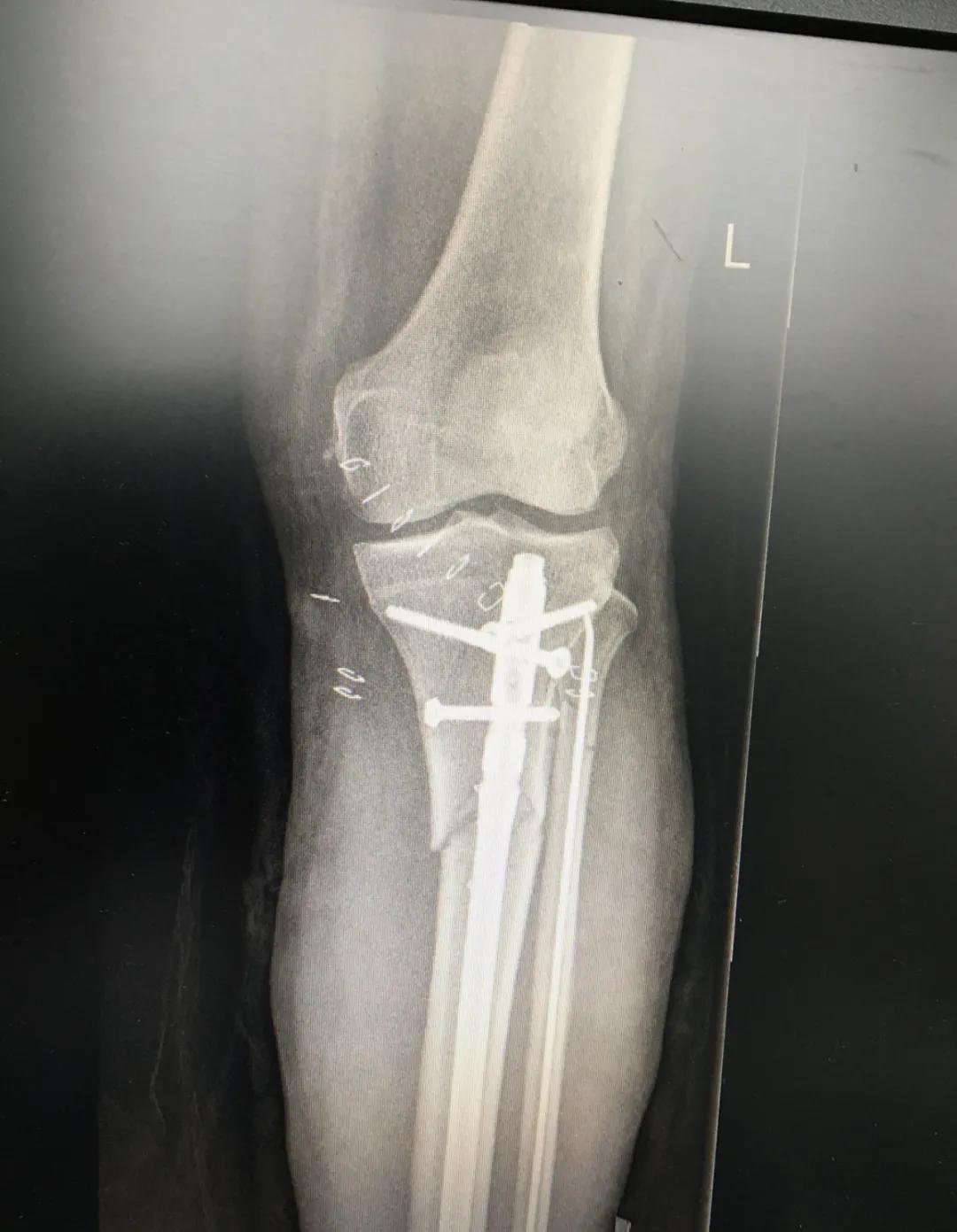 小腿骨断成三截了还能恢复吗,小腿断了三截能好彻底吗