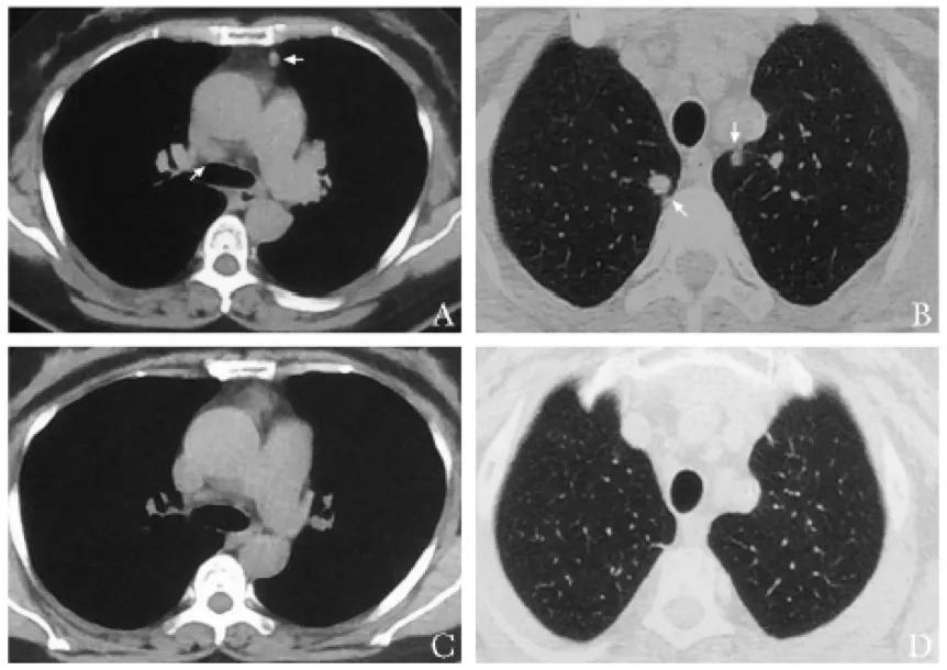 肺结节加重有什么明显症状,肺结节消失是什么原因
