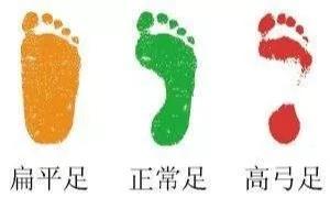 西安治疗扁平足最好的医院,扁平足拇指外翻的治疗方法