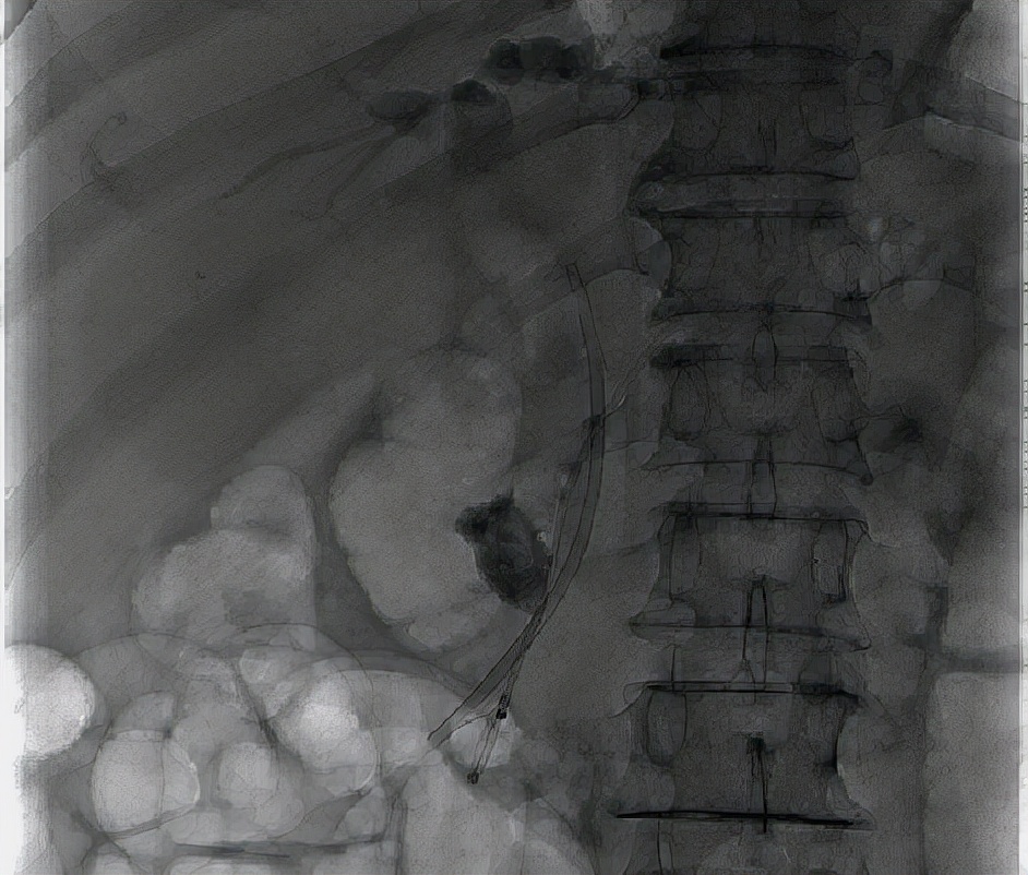 南大二附院消化内科红角洲院区胆胰团队成功完成一例经内镜下胰管巨大结石胰胆管支架联合置入术